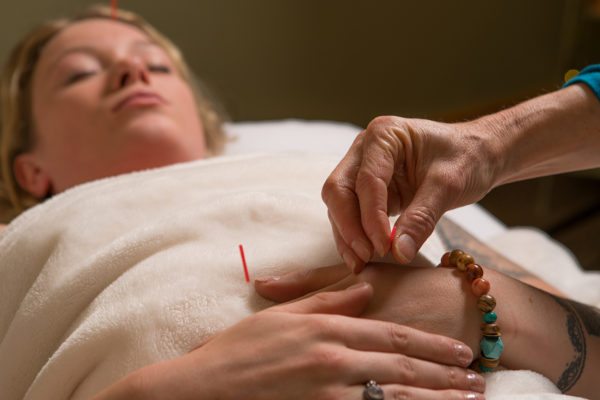 Acupuncture in action at The Sanctuary in Kings Beach
